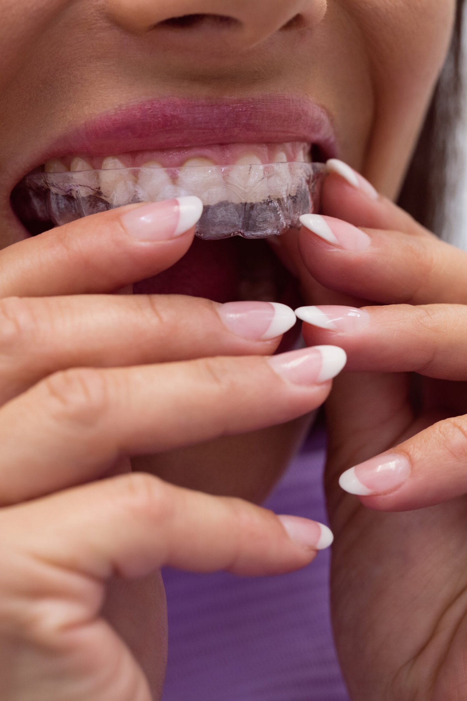 Chica colocandose un alineador en sus dientes